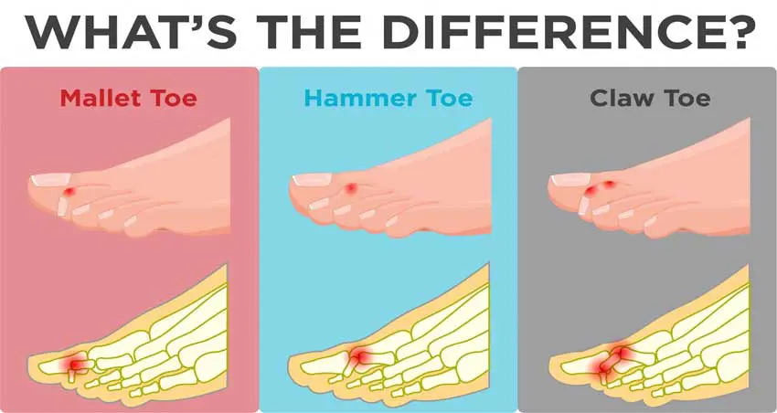 Understanding the How's and Why's of Hammer Toes - Active Care Podiatry